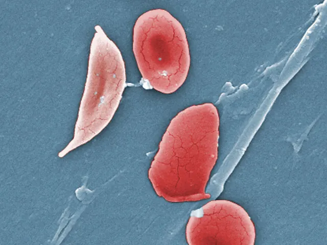 Colourised electron micrograph of a sickle-shaped red blood cell beside normal round red blood cells.